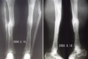 先天性脛骨假關節