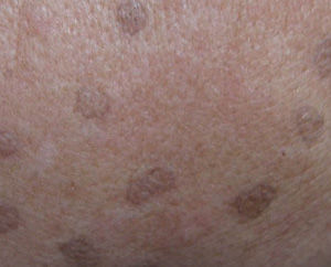 汗孔角化症 汗孔角化症