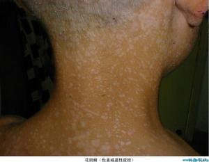 系統性紅斑狼瘡所致精神病