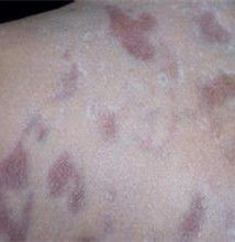 斑狀萎縮 斑狀萎縮