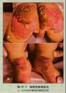 腸病性肢端皮炎 腸病性肢端皮炎