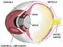 眼球破裂傷 眼球破裂傷