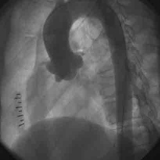 肌性室間隔缺損 肌性室間隔缺損