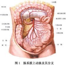腸系膜上動脈栓塞 腸系膜上動脈栓塞