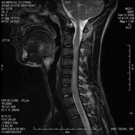 橫貫性脊髓炎 橫貫性脊髓炎