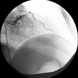 急性腦卒中 急性腦卒中