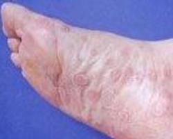 二期梅毒 二期梅毒