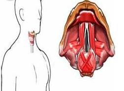 喉部腫瘤 喉部腫瘤