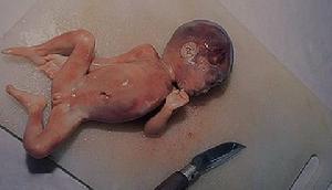 （圖）死胎