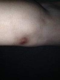 疤痕體質 疤痕體質