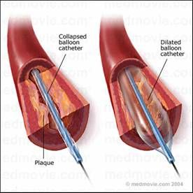 冠狀動脈粥樣硬化性心臟病