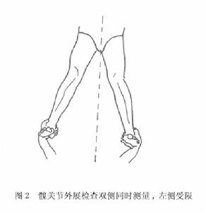 （圖）髖關節結核病
