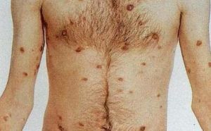 卡波氏肉瘤 卡波氏肉瘤