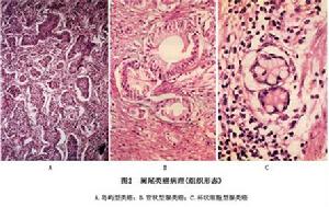 （圖）闌尾炎癌