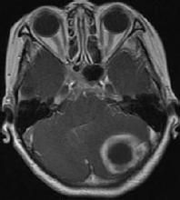耳源性腦膜炎 耳源性腦膜炎