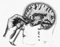 前腦葉白質切除術 前腦葉白質切除術