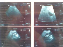 多發性膽結石 多發性膽結石