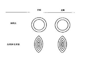 職業性白內障診斷標準