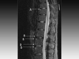 未分化脊柱關節病 未分化脊柱關節病