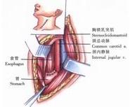 示意圖8:將食管同胃底進行端側吻合