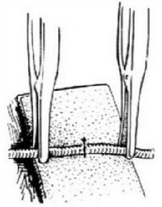 端端縫合術 端端縫合術