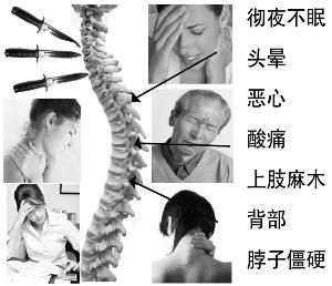 脊髓型頸椎病 脊髓型頸椎病