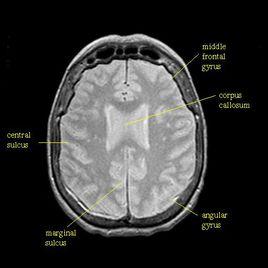 質子密度加權像 質子密度加權像