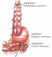 示意圖14:結腸-結腸端端吻合