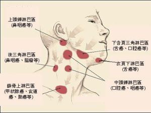 淋巴結腫大