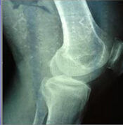 退行性膝關節病