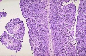 膀胱移行細胞癌 膀胱移行細胞癌