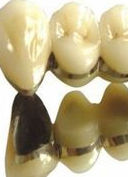 鈷鉻烤瓷牙 鈷鉻烤瓷牙