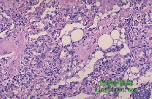 肺嗜酸細胞組織細胞增生症