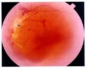 單純皰疹性葡萄膜炎