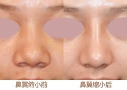鼻尖整形術 鼻尖整形術
