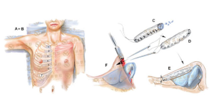 土耳其軟糖隆鼻 土耳其軟糖隆鼻