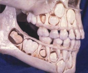 牙槽骨突出