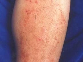 季節性皮炎 季節性皮炎