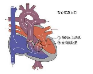 小兒右室雙出口 小兒右室雙出口