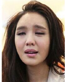 面神經麻痹 面神經麻痹