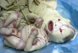 火棉膠樣嬰兒 火棉膠樣嬰兒