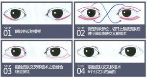 矯正眼瞼外反