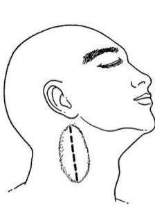 腮裂囊腫 腮裂囊腫