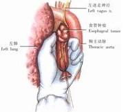 示意圖5:切斷並結紮條索狀物