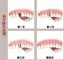牙齒缺失種植圖解