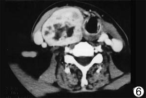 原發性甲狀腺惡性淋巴瘤
