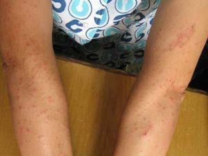 日光皮炎 日光皮炎