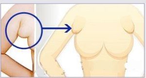 副乳切除術 副乳切除術