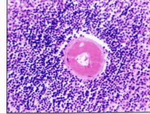 自身免疫性淋巴細胞增生綜合徵 自身免疫性淋巴細胞增生綜合徵