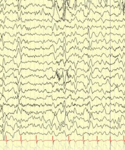 異常腦電圖